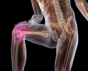 Лечение артроза - что делать при болях в коленях