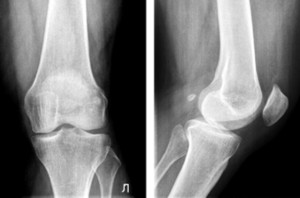  Деформирующий остеоартроз коленного сустава