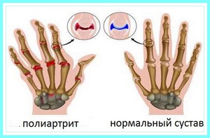 Полиартрит пальцев рук  - симптоматика