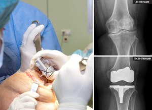 Операция на коленный сустав