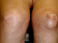 Как проявляется бурсит коленного сустава