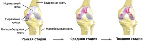 Степени артроза колена показаны на схеме