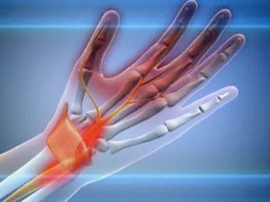 Причины онменеия пальцев рук
