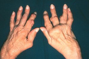Тяжелая стадия артрита  - руки практически не действуют