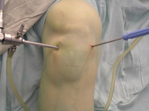 Коленный сустав восстанавливают хирургическим путем