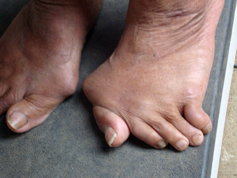 На фото - деформация пальцев стопы