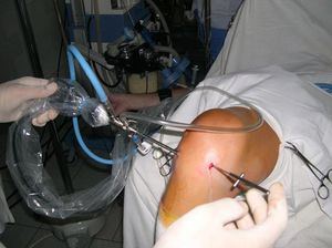 Методы оперативного хирургического лечения артроза
