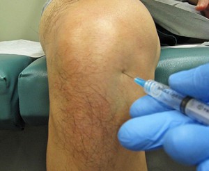 Изображение - Для чего вводят гель в коленный сустав ukoly-pri-artroze