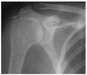 Как выглядит артрит  плеча на рентгеновском снимке