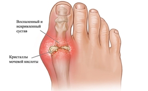 Схема артрита большого пальца ноги