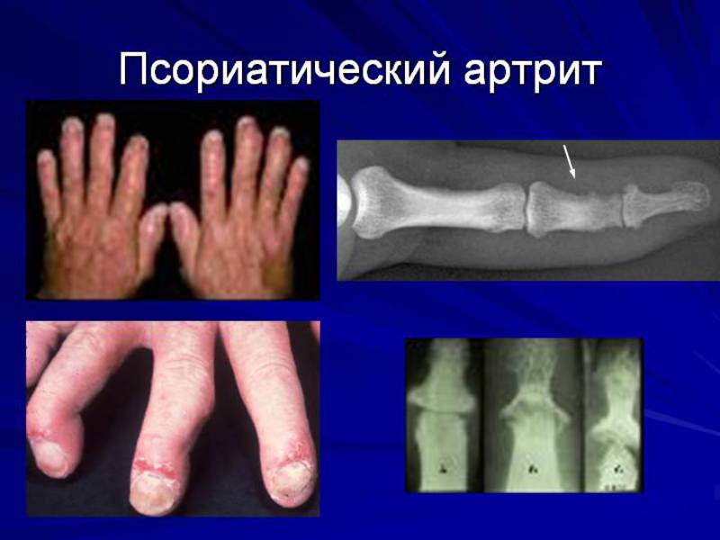 Симптомы псориатического артрита
