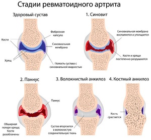Стадии артрита показаны на рисунке