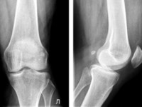 Деформирующий остеоартроз коленного сустава