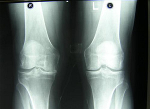 Артроз и остеоартроз коленного сустава