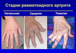 Стадии артрита пальцев рук - фото