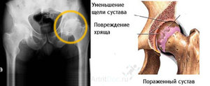 Реактивный артрит суставов - что это такое?