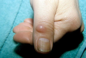 Гигрома пальца - методы лечения