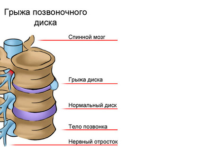 Грыжа позвоночника картинки снаружи и внутри