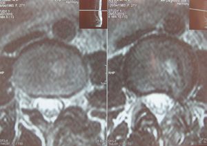 На снимке МРТ показана грыжа Шморля