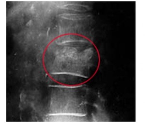 Рентгеновский снимок больного с грыжей Шморля