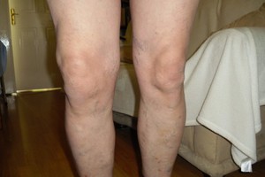 Описание заболевания артроза коленных суставов