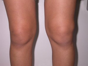 Симптомы острого синовита колена