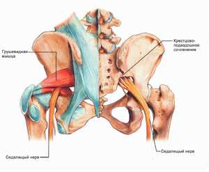 Синдром грушевидной мышцы остеохондроза