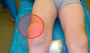 Методы лечения бурсита коленного сустава