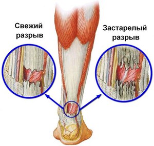 Последствия разрыва коленного сустава