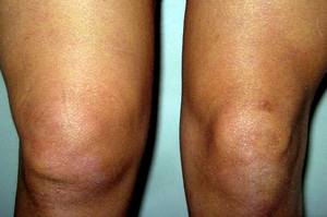 Изображение - Как выглядит мениск коленного сустава otekpravogokolennogosustava