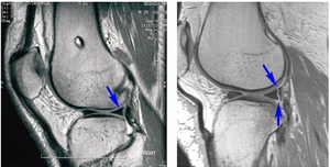 Изображение - Как выглядит мениск коленного сустава -razryiv-zadnego-roga-meniska-na-rentgenovskom-snimke