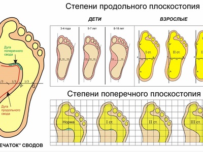 Поперечное плоскостопие симптомы и лечение фото