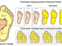 Степени продольного плоскостопия