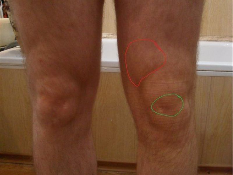 Диагностика бурсита коленного сустава