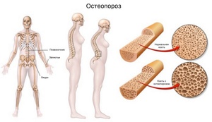 Остеопороз у женщин  - причины и симптоматика
