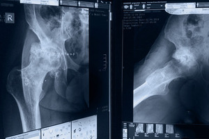 Рентген тазобедренного сустава - что он может показать?