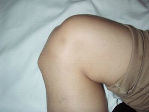 Болезнь Шляттера - на фото видно, как она прявляется на коленных суставах