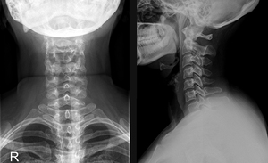  Рентгенография позвоночника - область шеи