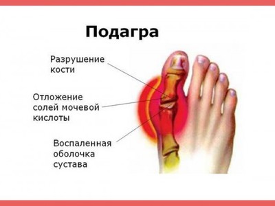 Признаки подагры у женщин и методы лечения фото