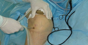 Показания для проведения хирургического вмешательства для лечения мениска колена