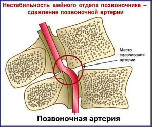 Сдавливание шейной артерии при смещении позвоночника