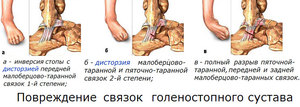 Степени повреждения суставов голеностопа показаны на рисунке