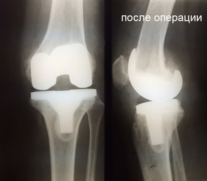 Рентген гонартроза - на снимках сравнение здорового колена и больного