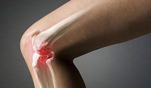 Гонартроз коленного сустава - можно ли обойтись без операции