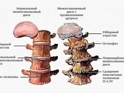 Остеохондроз поясничного отдела позвоночника фото