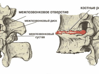 Хондроз грудной карта вызова