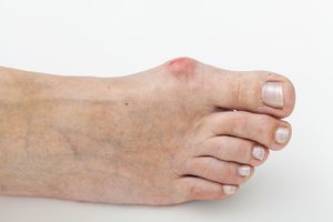 Боль в суставе большого пальца ноги