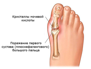 Боль в суставе большого пальца ноги