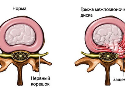 Схема лечения защемления седалищного нерва