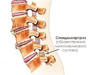 Как лечат заболевание спондилоартроз